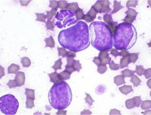 Leucemia linfoblastica aguda